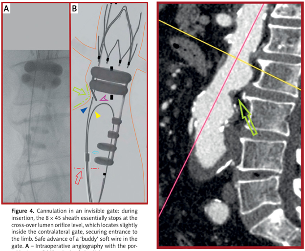 Maintaining functionality by graft interposition in a Brescia-Cimino arteriovenous fistula